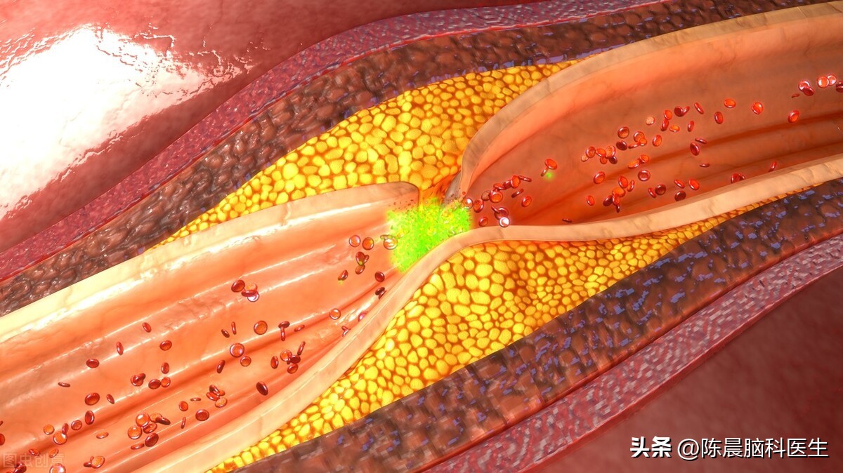 脑梗怎样提前预防有效果,脑梗怎么提前干预