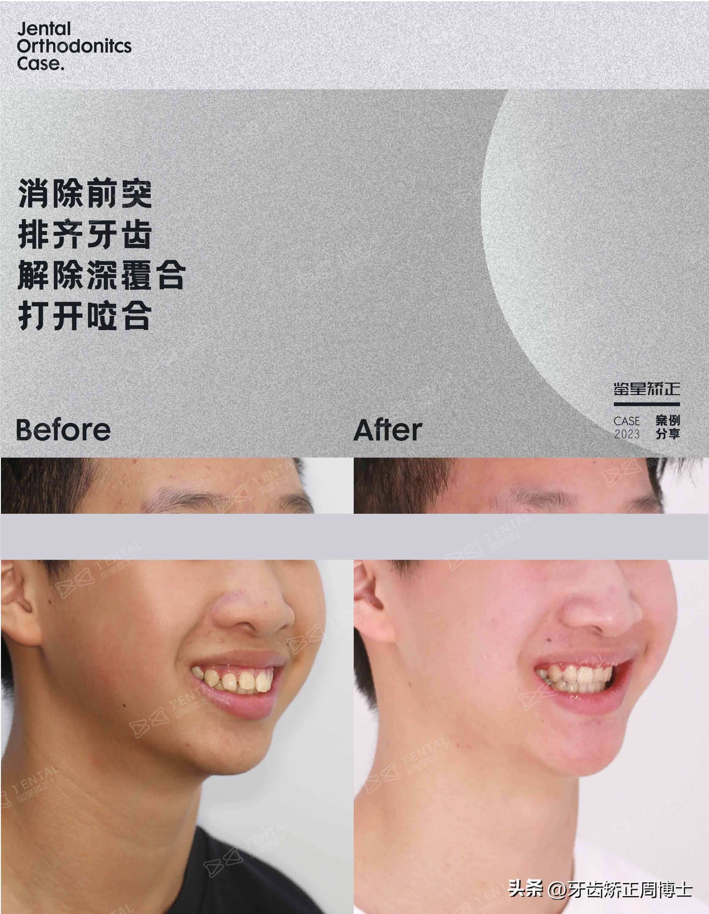 拔掉大牙做矫正好还是植牙好,拔掉4颗牙齿正畸收缝有几种方法