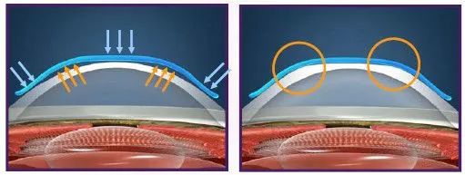 南阳南石眼科医院角膜塑形镜,南石医院角膜塑形镜