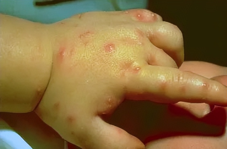 夏日带孩子户外活动当心这种虫,暑期带娃小心毒虫