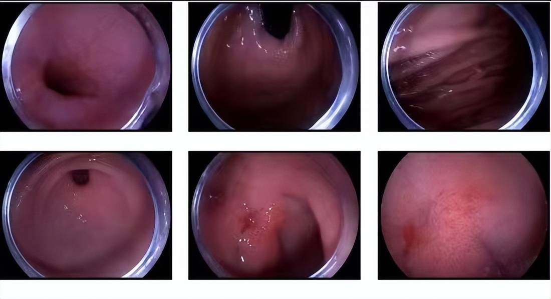 老年人吃降压药突发脑梗,七旬老人误服药物引发中毒
