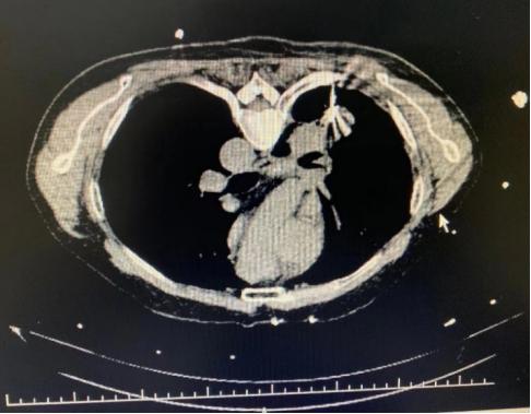 介入穿刺全过程,介入穿刺技术