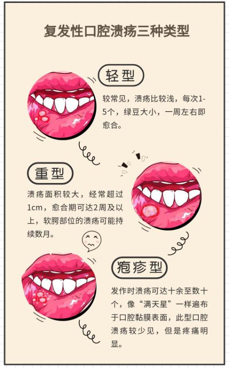 反复口腔溃疡是哪种免疫系统病,反复长口腔溃疡的风湿性疾病