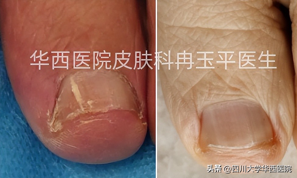灰指甲到底算什么病,指甲黄是不是灰指甲