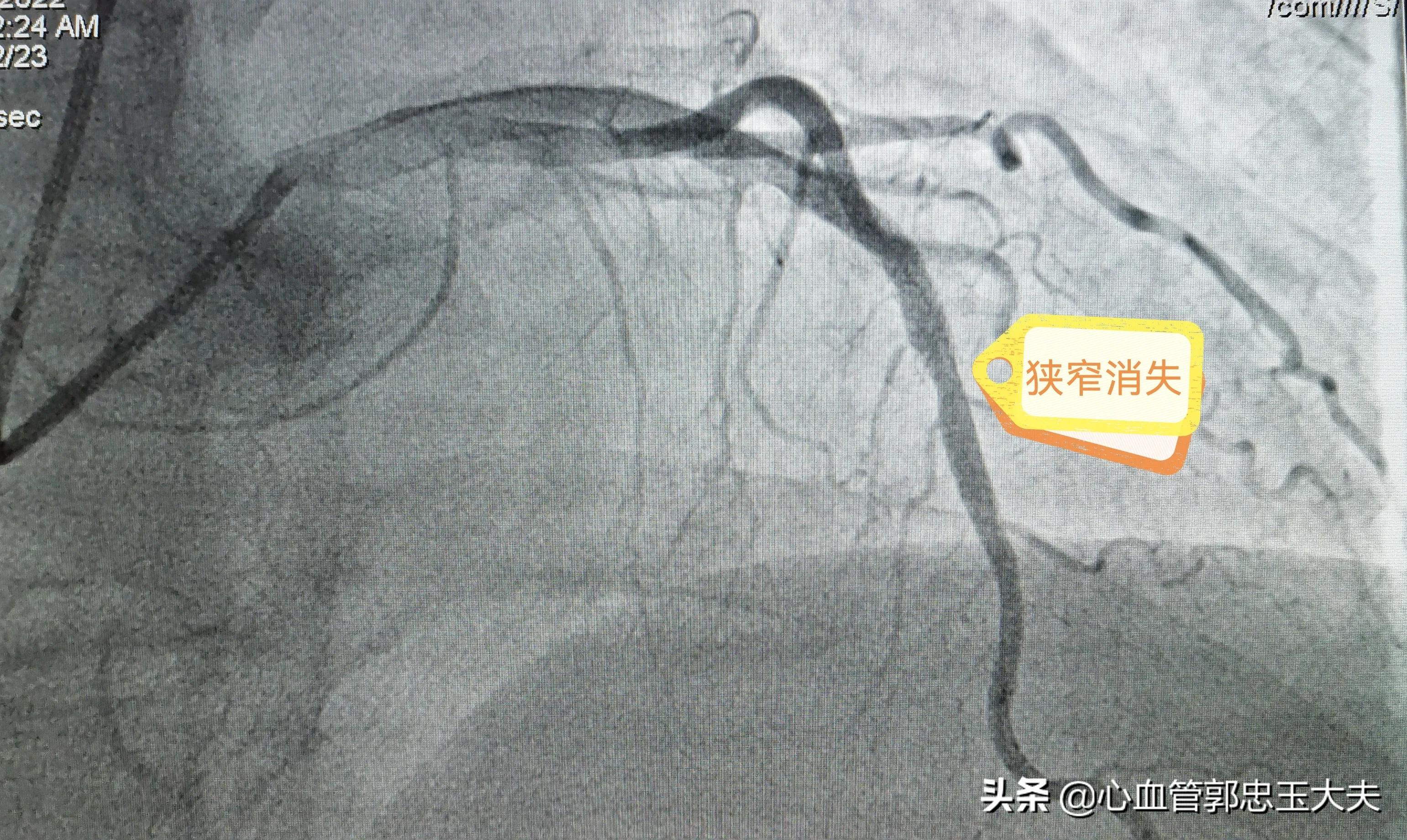 为什么支架内更容易堵,指标正常但支架内再狭窄