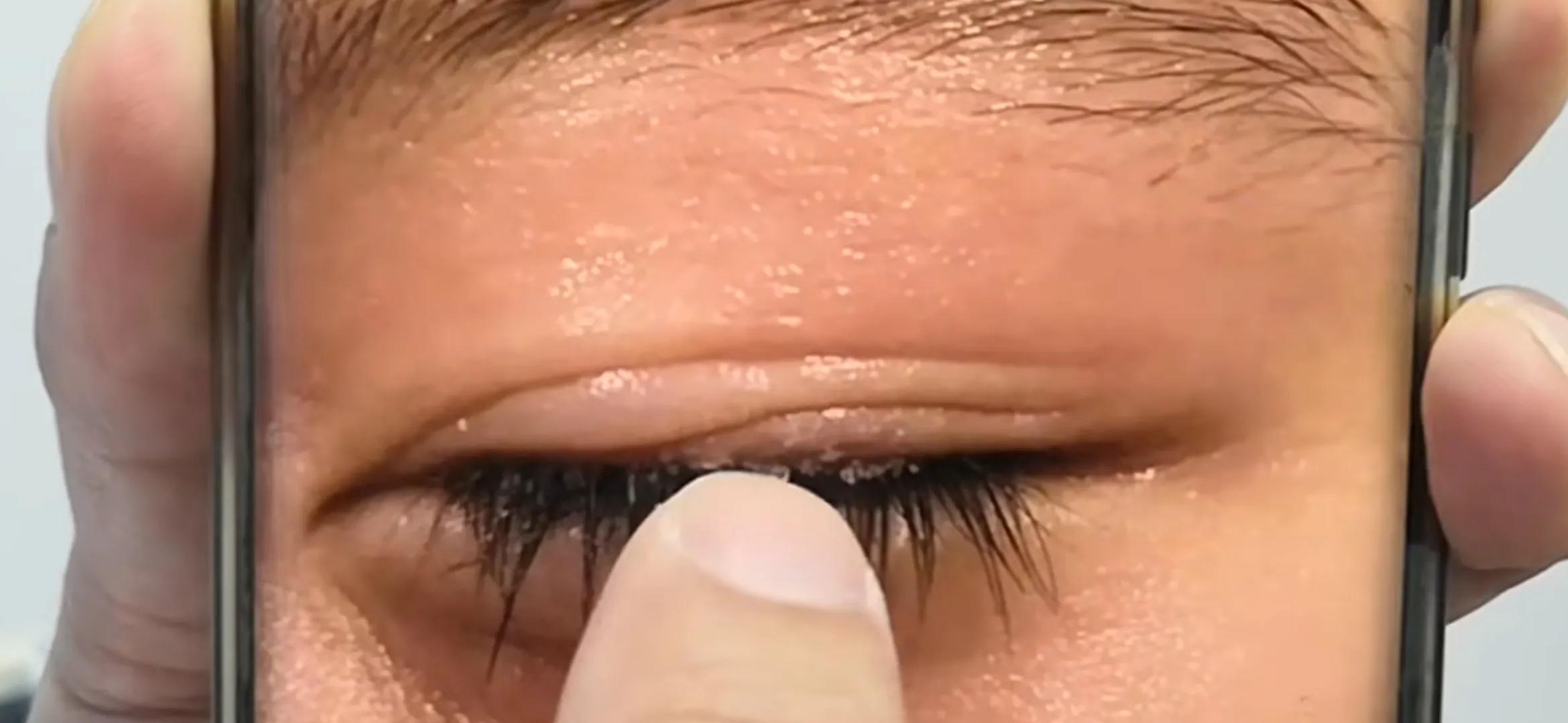 8岁男童做手工误被502粘住眼睛，妈妈错误操作险些酿成大错