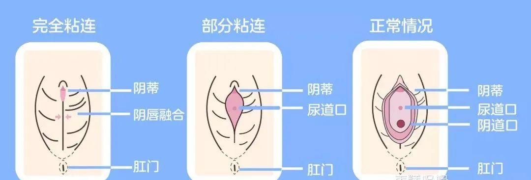 女童粘连哪里能看好,女童粘连最简单处理方法