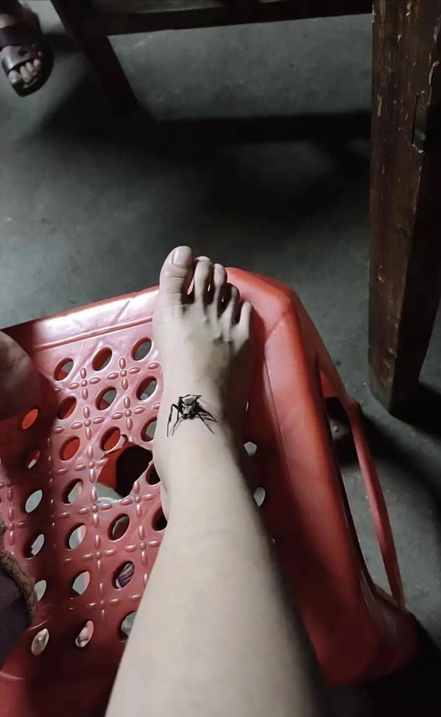 女孩被毒蜘蛛咬伤,女子遭毒蜘蛛咬伤