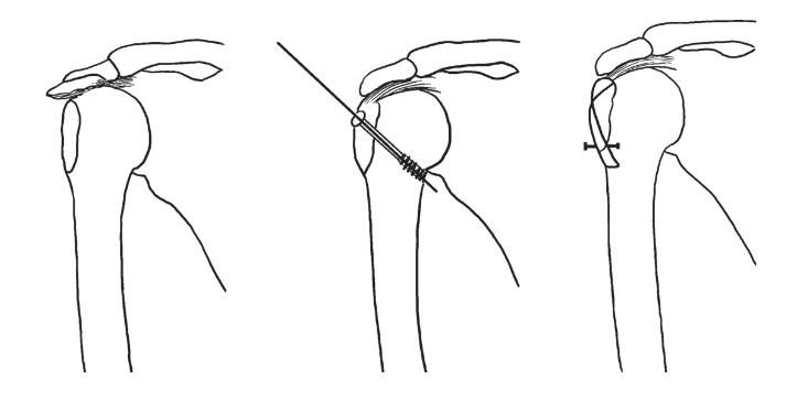 四个注意全面预防骨质疏松,4个要点的剖析