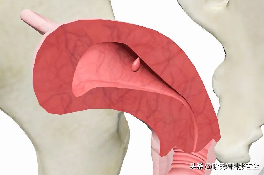 子宫内膜息肉中医可以消除吗,子宫内膜息肉中医怎么调理