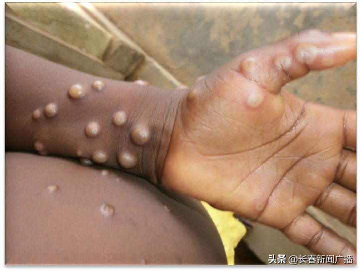 猴痘病毒图片,猴痘图片大全