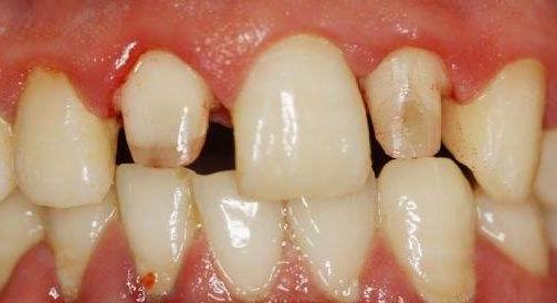 牙齿地包天导致骨头严重畸形,牙齿畸形缺失地包天怎么办