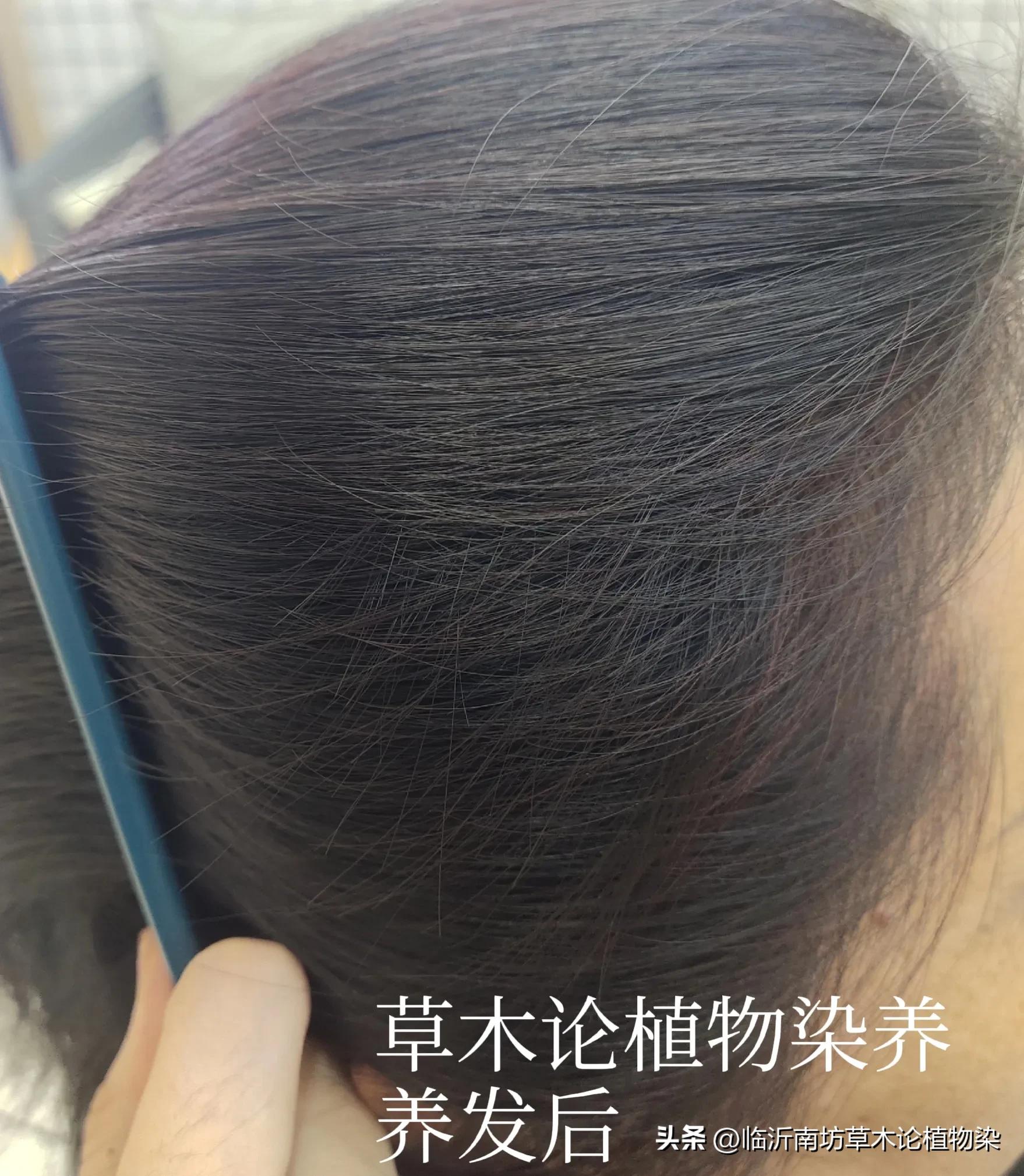 染发过敏头皮痒最快解决方法,染发头皮过敏流水结痂会自愈吗