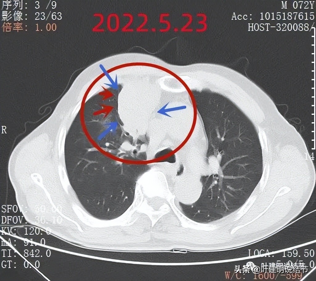 经验：肺占位超6厘米，不是癌还会是什么？临床上仍得多个心眼