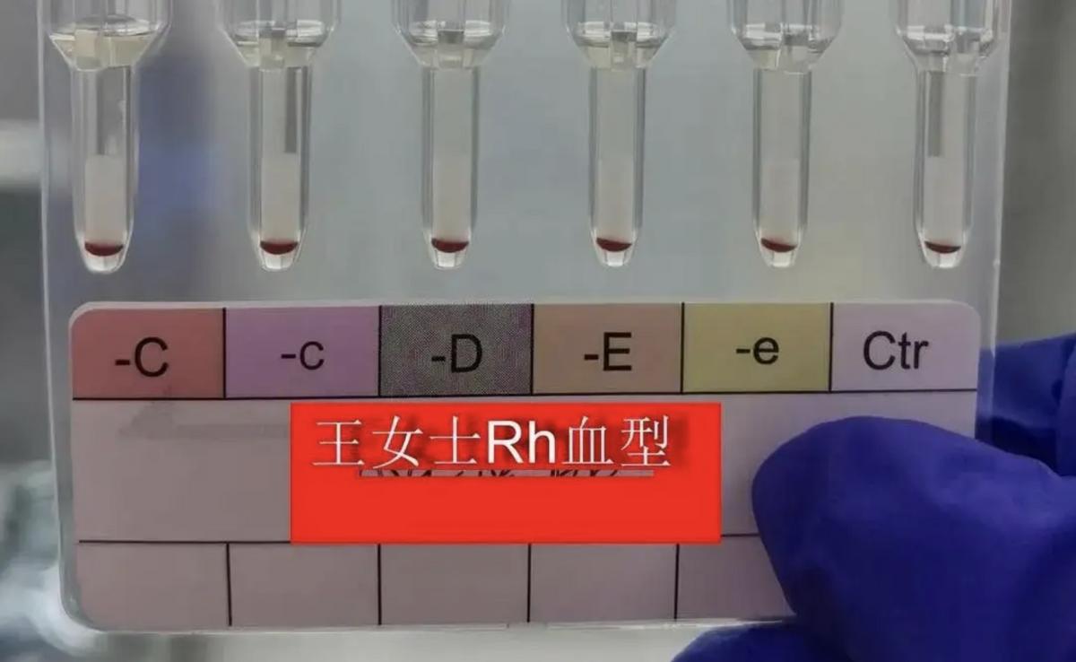 全球不到100例的疾病,史上最罕见的熊猫血