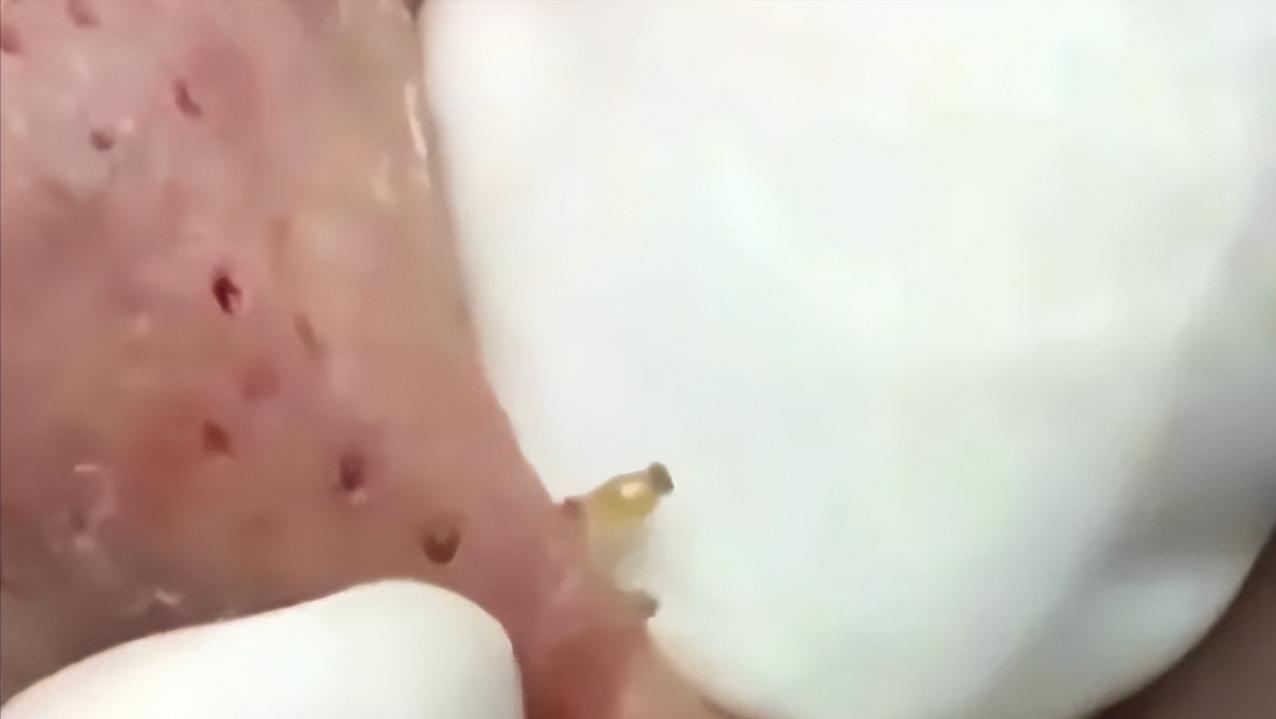 鼻子上有黑点怎么抠掉,鼻子边缘的小白点怎么去除