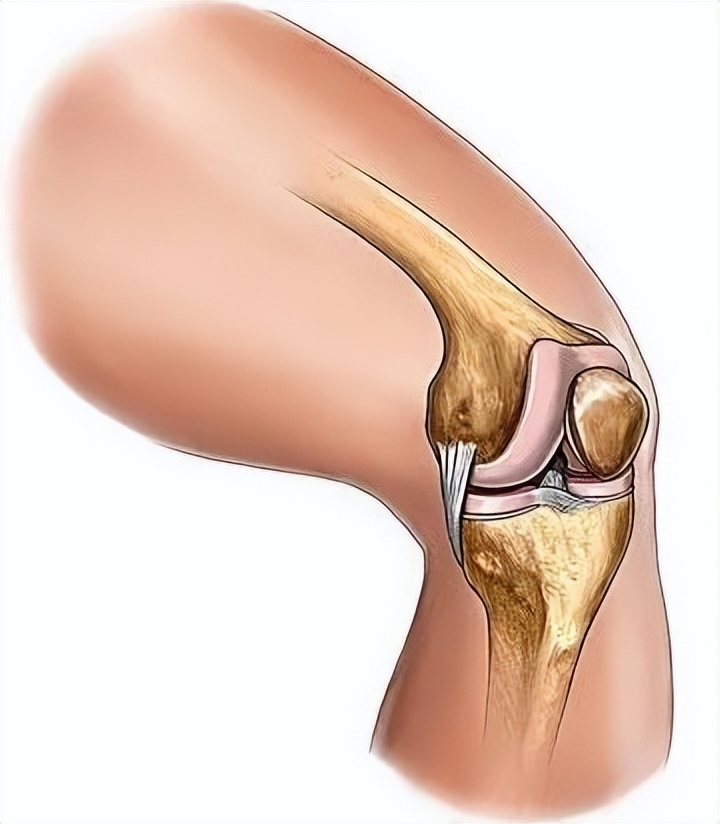 半月板保护用护膝还是髌骨带,半月板是消耗品吗