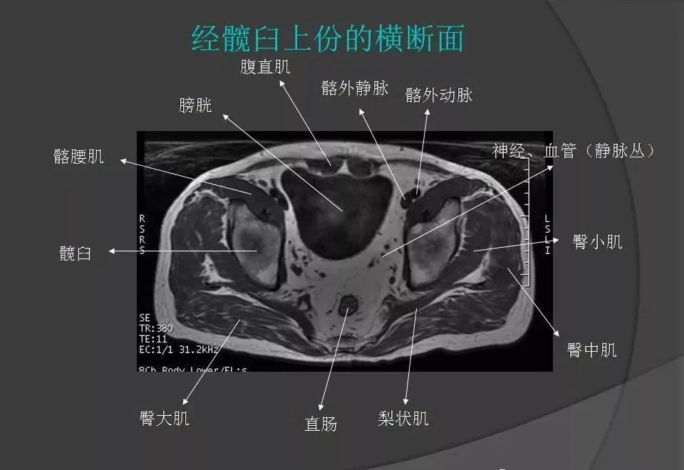 女性盆腔ct连续断层解剖图,盆腔mri影像病例分析