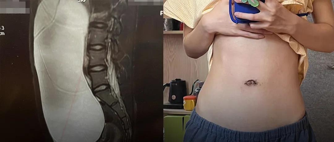 肚脐里长馒头状的肿物,肚脐上方摸到好多类似结节的疙瘩