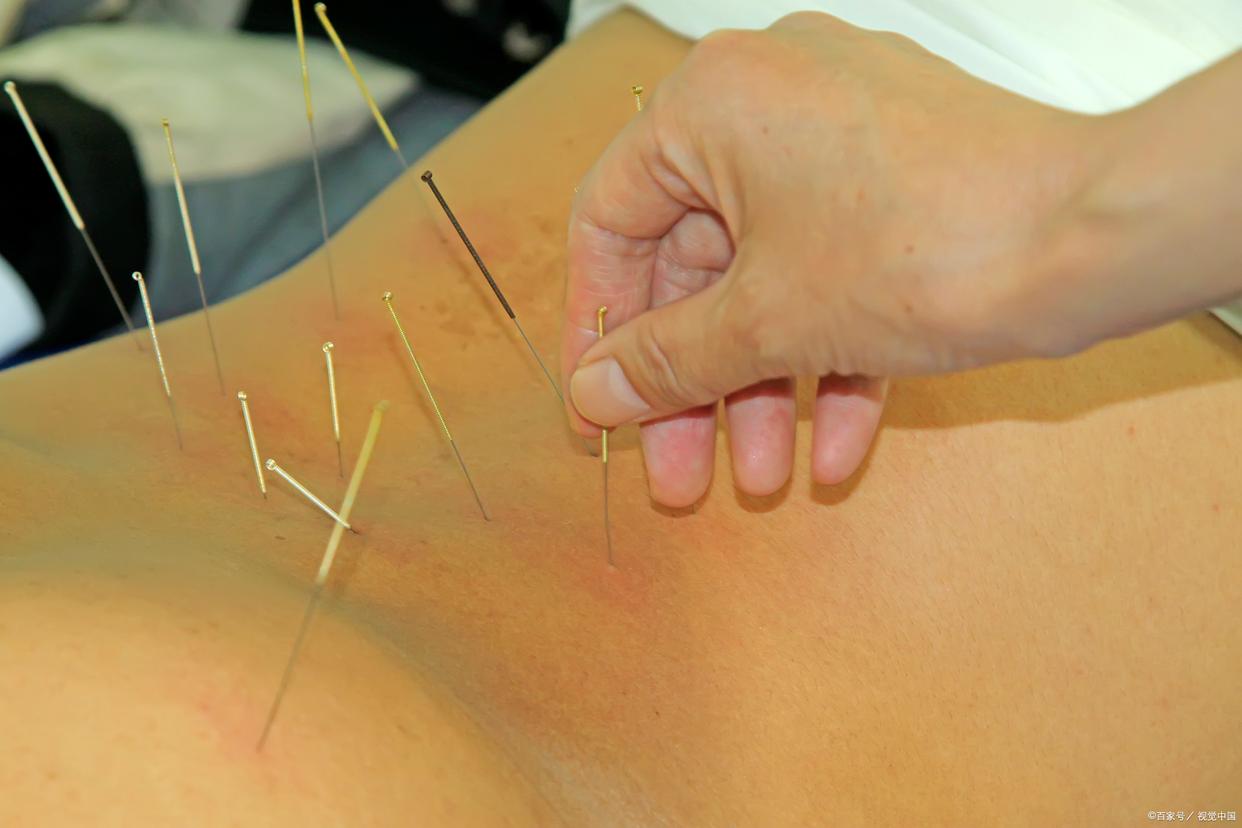 针灸把肺扎破了报警能赔多少钱,针灸扎到血管了会有事吗