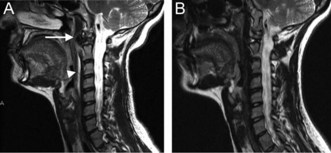 颈椎常见病变图片,颈椎严重的病例