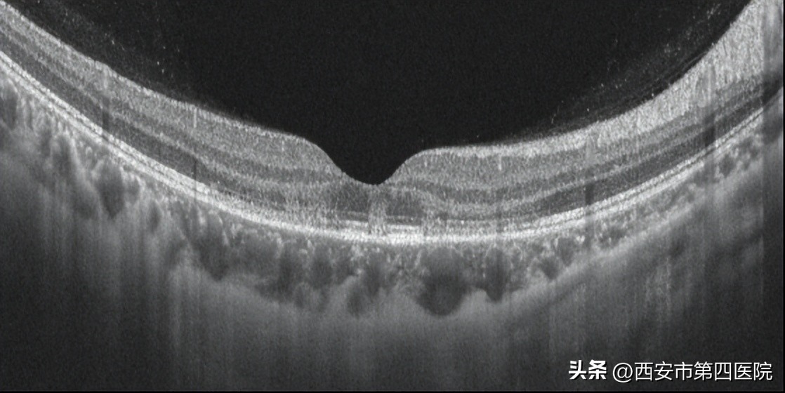 #新冠防疫手册#33岁女士“阳康”后视力下降、模糊、黑影……