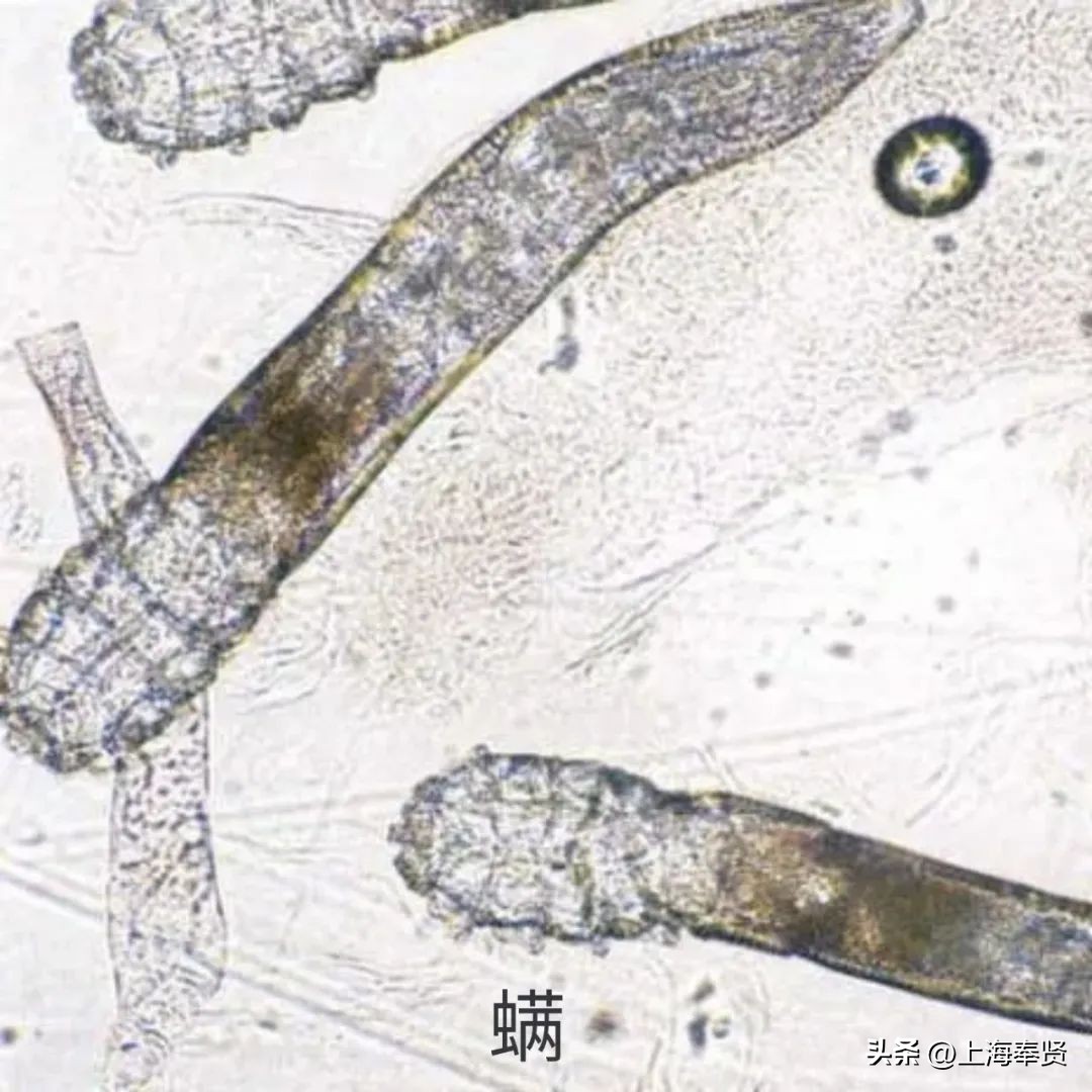 夏天虫咬皮炎的治疗方法,虫咬性皮炎到底如何杀虫