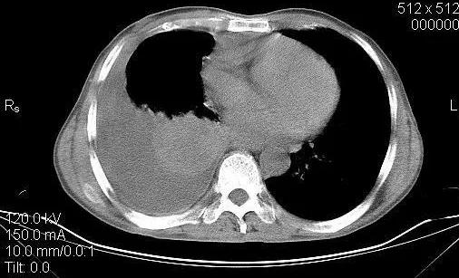 肺癌治愈后肺炎是不是可以自愈,肺炎因病情恶化经抢救无效