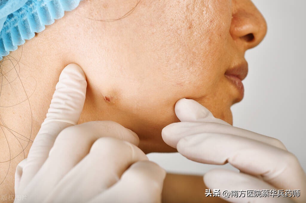 喝什么中药消散身上结节,四味药方横扫结节息肉