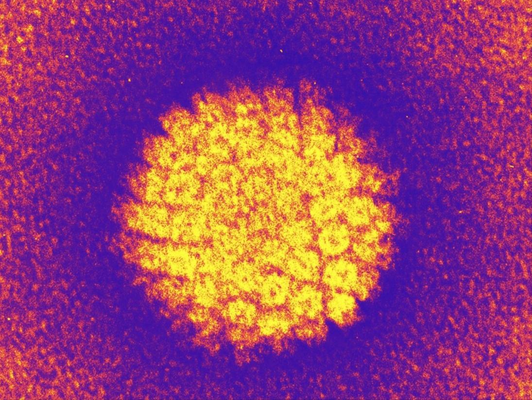 派特灵检测hpv靠谱吗,感染hpv派特灵怎么用在宫颈