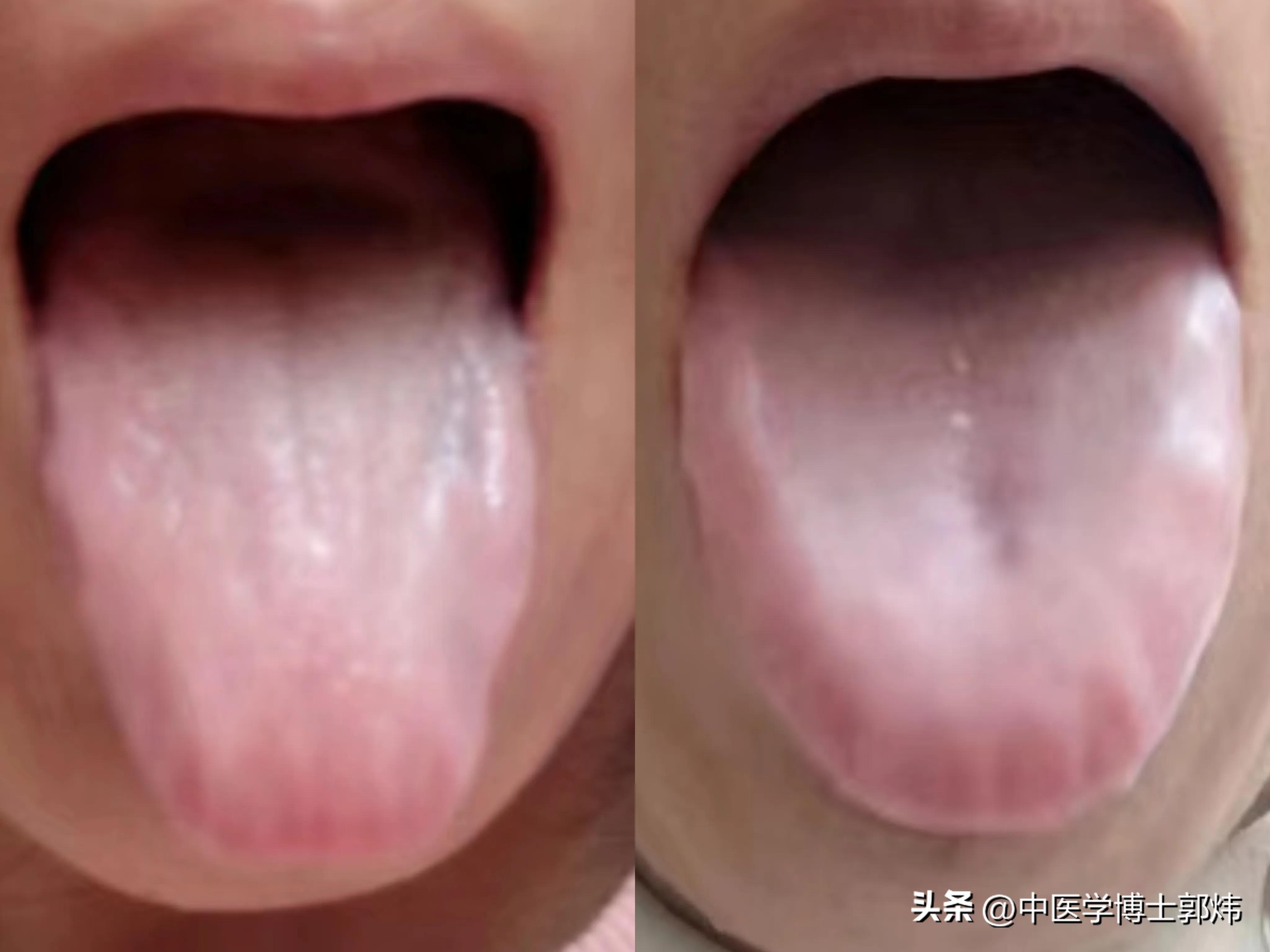 舌上舌下瘀青怎么治,舌边有瘀血吃什么中成药