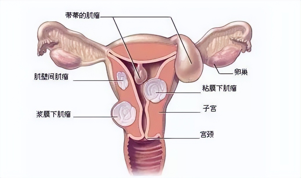 如何从报告看出子宫肌瘤,从中医角度看子宫肌瘤形成原因