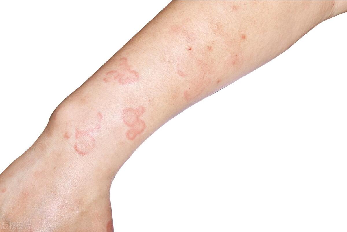 皮肤病忌口什么发物,发物会加重皮肤病吗