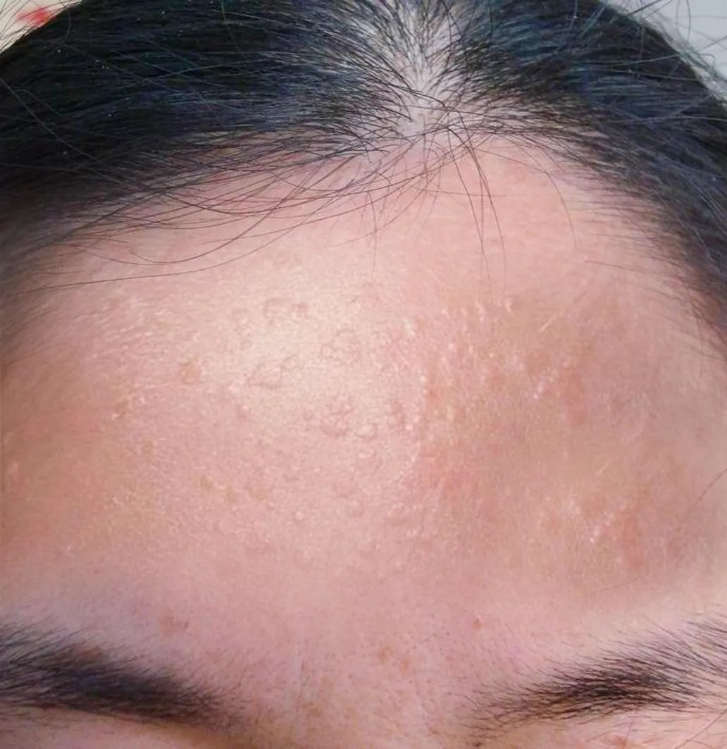 感染HPV都有些什么症状,感染hpv42没有症状有必要治疗吗