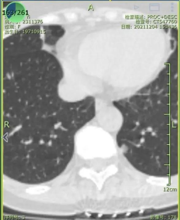 九个月内出现6mm磨玻璃结节,6mm的磨玻璃结节微浸润