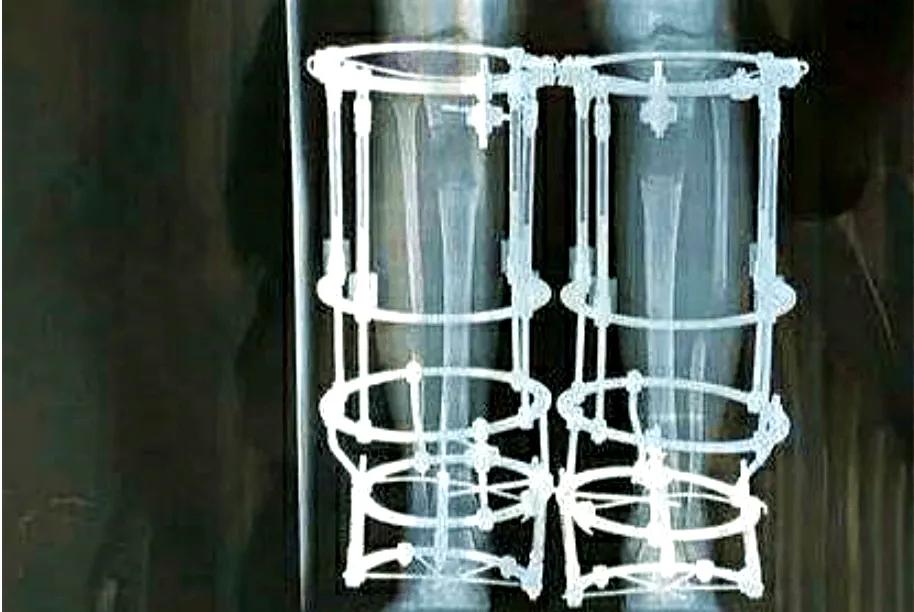 高中生花6.5万断骨增高,1米58男子花1500万增高