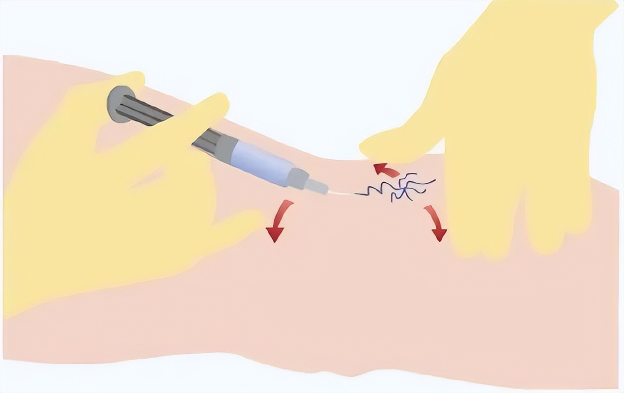 跷二郎腿静脉曲张怎么治,静脉曲张跷二郎腿有好处吗
