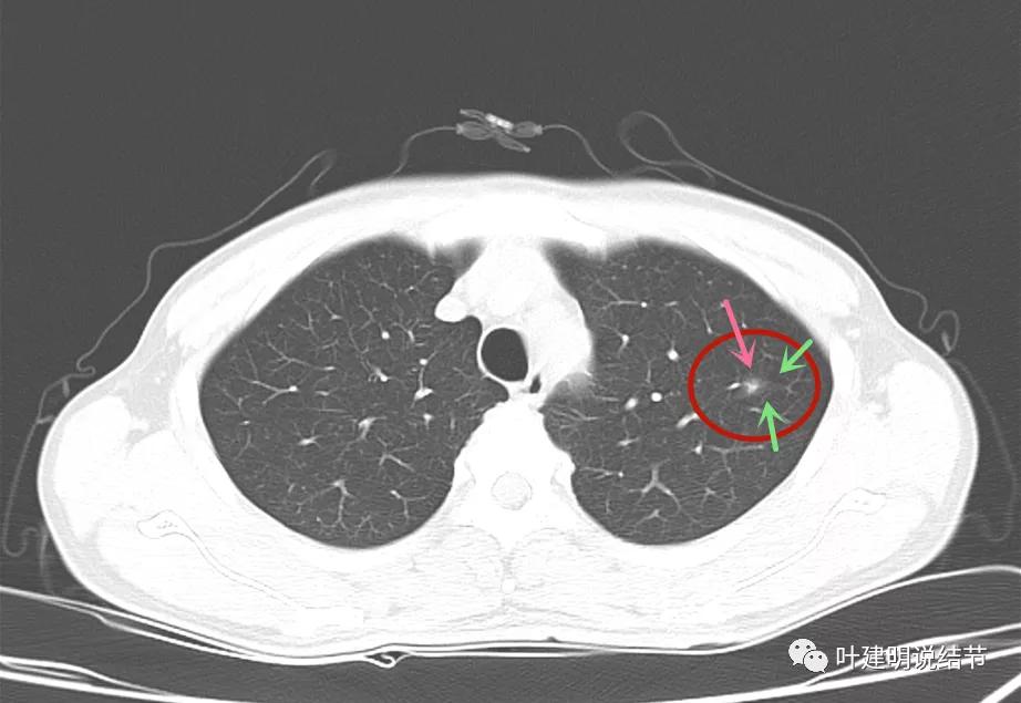 这样的多发病灶给试验性抗结核治疗?消失的结节是药的功劳吗?