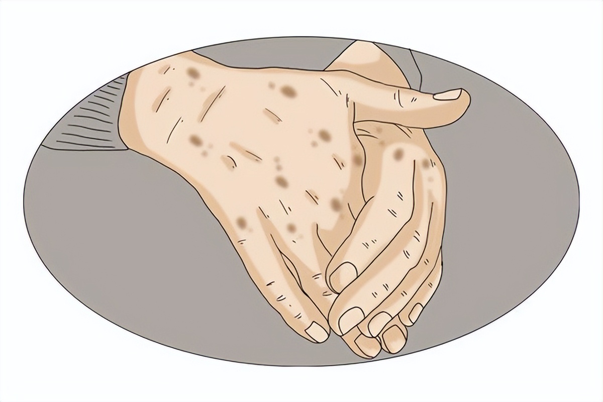 祛老年斑涂抹什么药膏有效,快速消除老年斑的小妙招红霉素