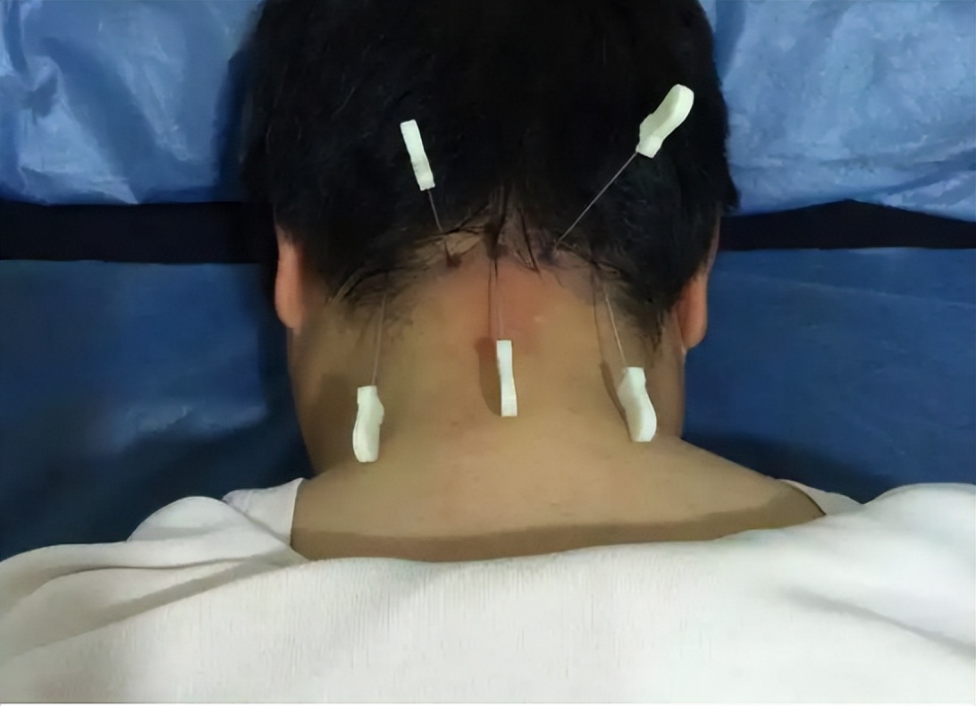 持续性头晕中医能治疗吗,头晕可以要中医调理吗