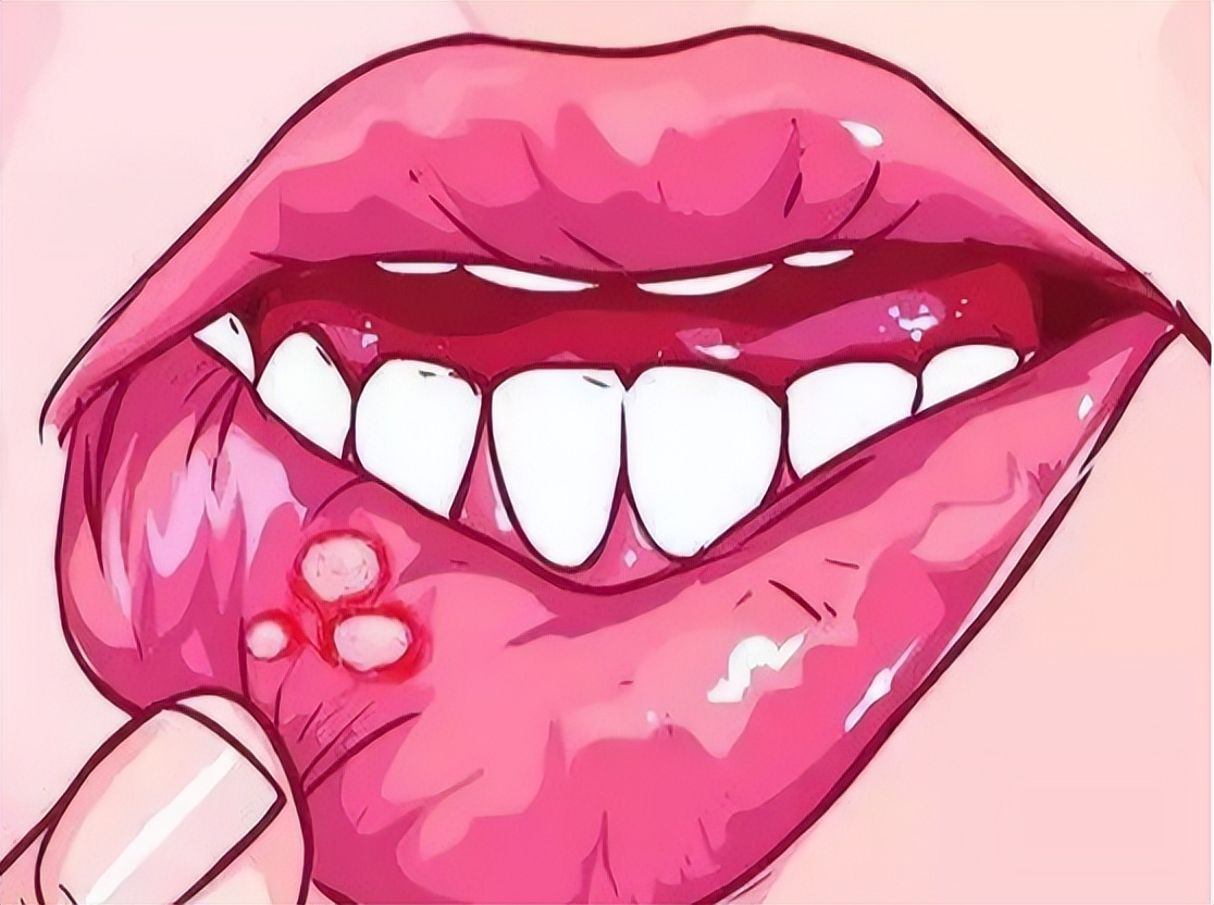 有这四个小妙招口腔溃疡轻松解决,7种方法助你减轻口腔溃疡痛苦