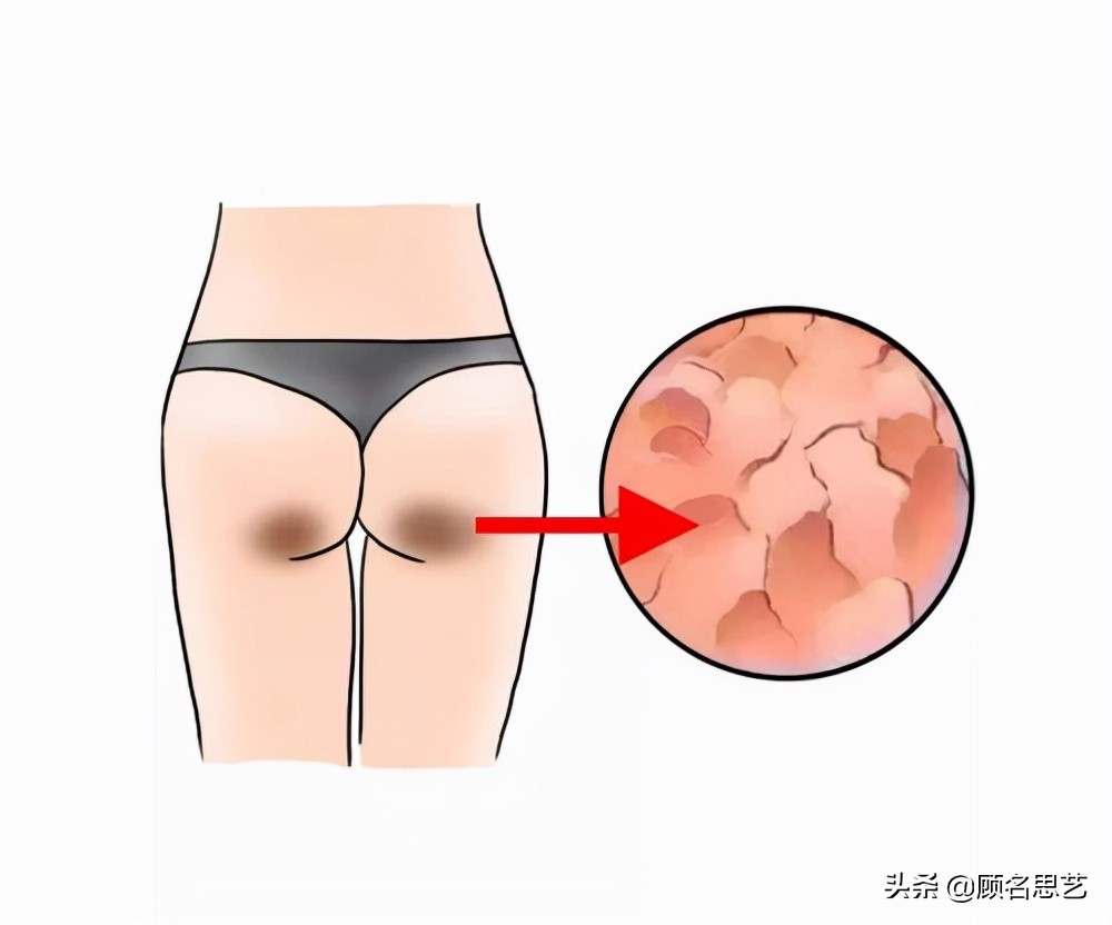 屁股上坐出来的黑色印子怎么消除,屁股上有两条黑色印子是什么原因