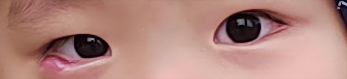 感谢伟大的中医,记录小儿霰粒肿康复之路