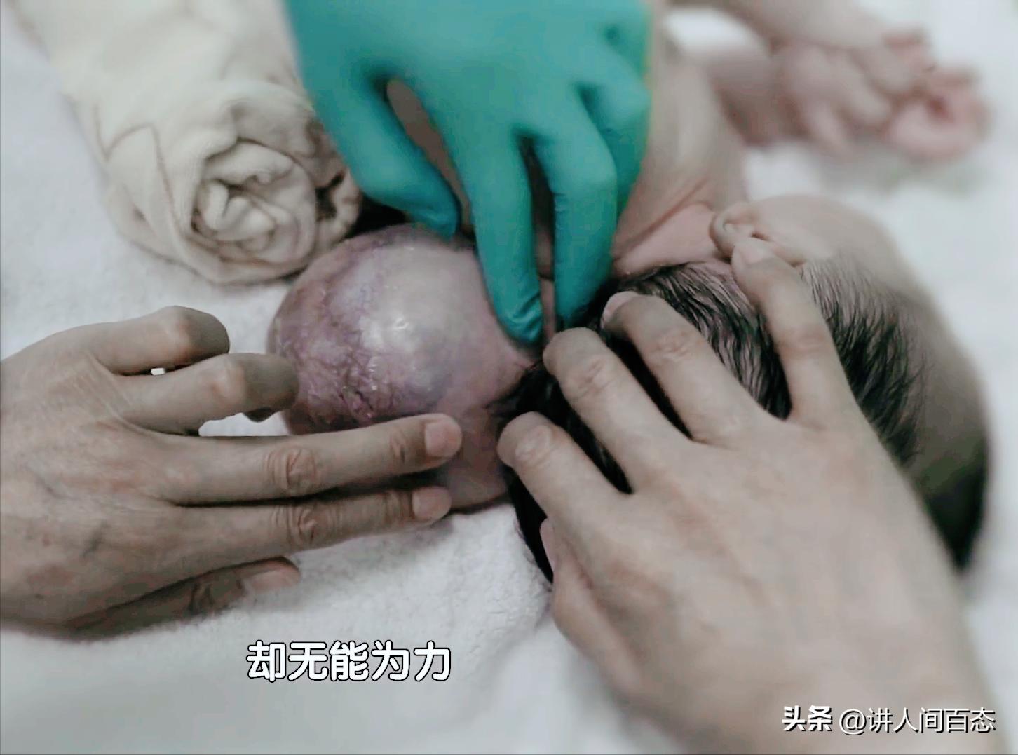 被父母扔桥洞等死，头部巨大瘤子溃烂流脓，出生17天*儿命婴**悬一线