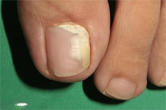 甲癣不严重怎么治疗,甲易生治疗灰指甲吗