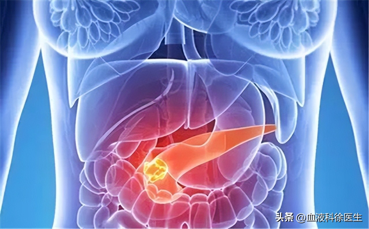 得了胰腺癌真的无药可救了吗,如果得了胰腺癌还能活多久