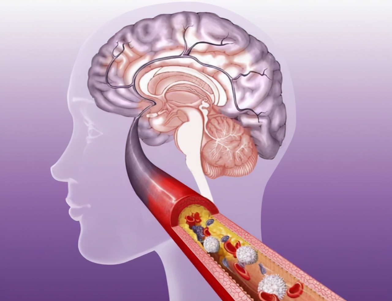 血栓大王,血栓大户被揪出要少吃甜食