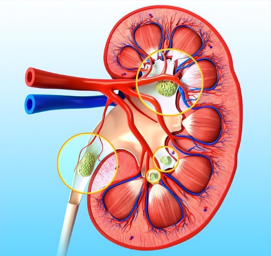 检查有肾结石没有症状应注意什么,肾结石没什么症状怎么办