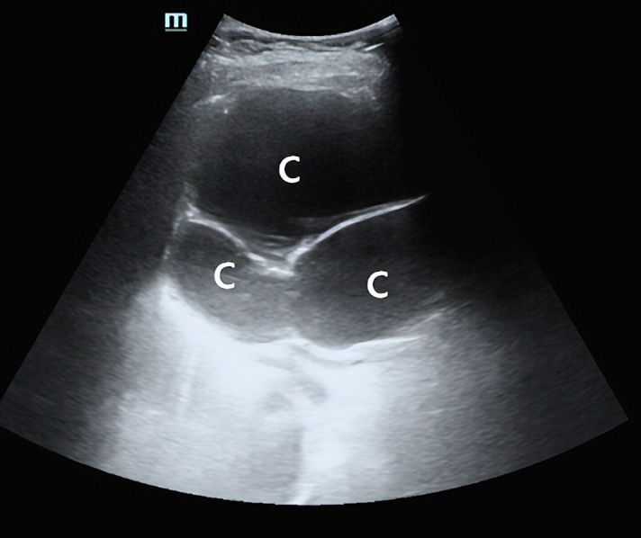 专家讲解多发肝囊肿治疗视频,多发性肝囊肿适合什么手术