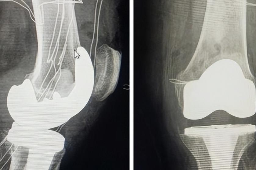 骨盆趾骨骨折后最佳的物理疗法,骨科创伤的救治